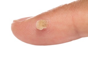 A wart is a skin disease, which can effectively fight Skincell Pro