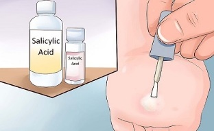 How to remove papillomas by folk methods