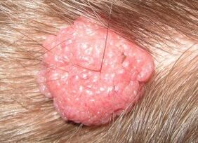 how to remove papillae on head