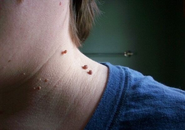 papilloma on the neck