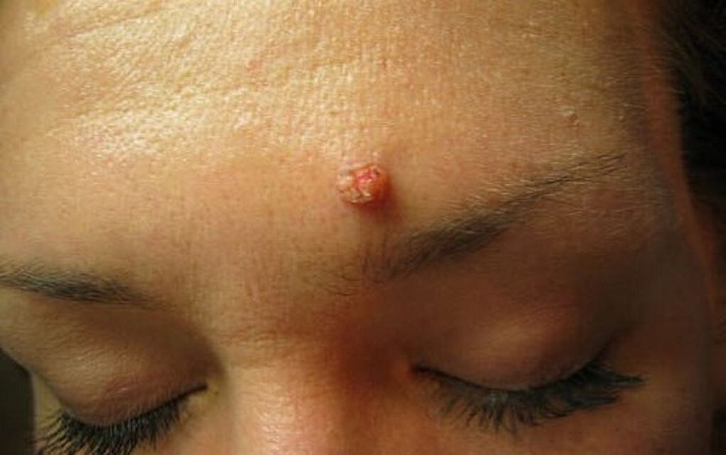 Warts on forehead