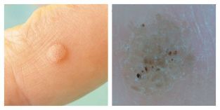 Warts are common during skin exams and exams
