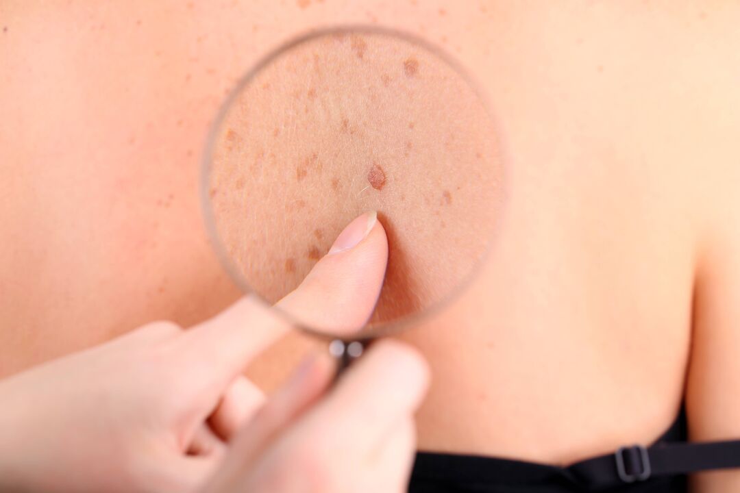 Skin papillomas can be removed at home